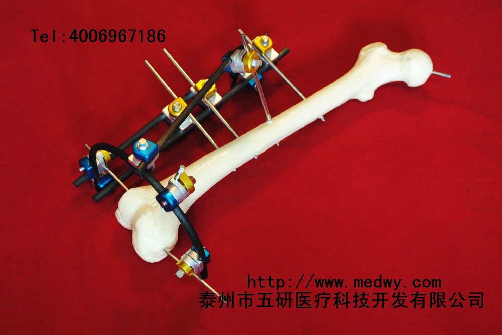 骨折、關(guān)節(jié)炎與四肢畸形患者福音