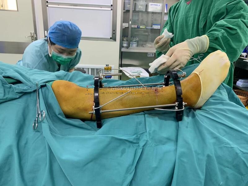 【望京醫(yī)院】不開(kāi)刀治骨折——右脛腓骨骨折病例分享